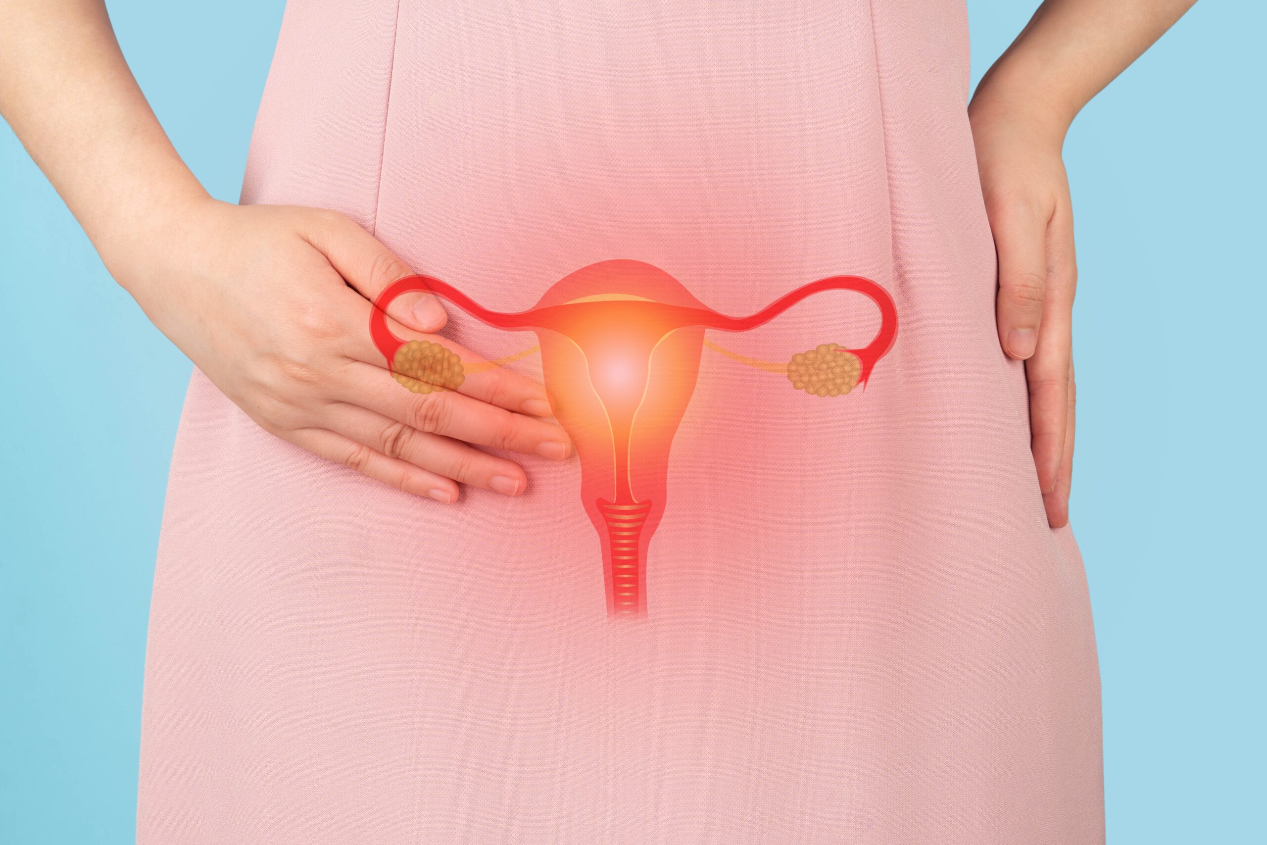 Adenomyosis