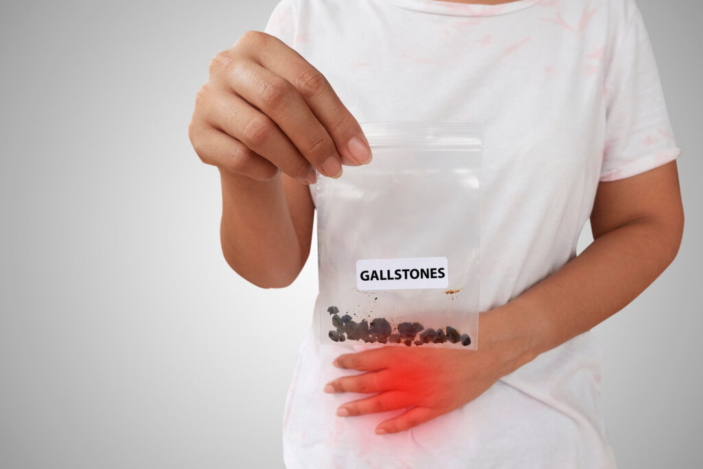 Gallstones 6 Gall stones scaled