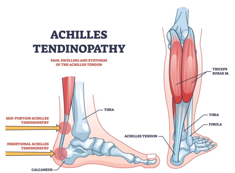 Achilles,Tendinopathy,As,Injury,To,Tendon,In,Heel,Outline,Diagram.