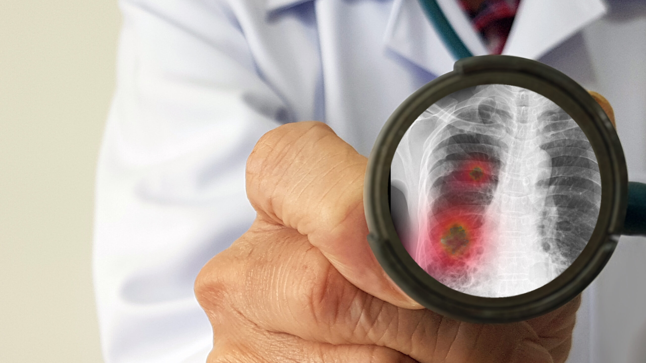 pneumonia