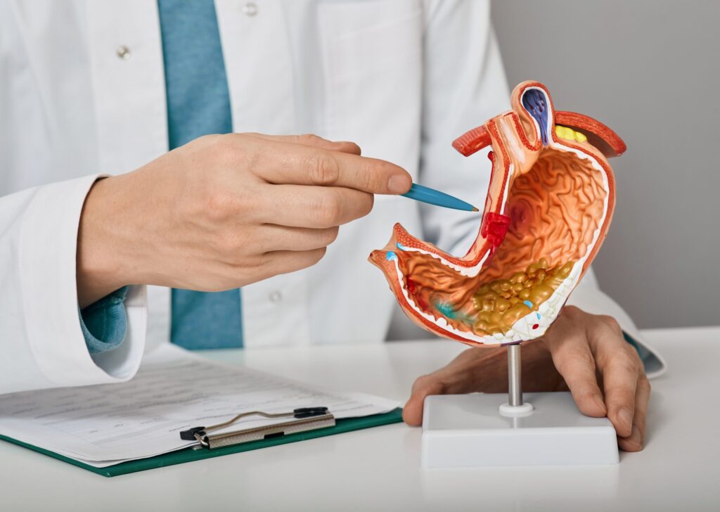 Peptic ulcer disease 2 Ulcer scaled