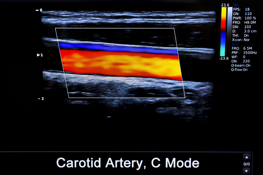 Carotid ultrasound: the #1 screening test to detect hidden vascular risks 1 Carotid ultrasound