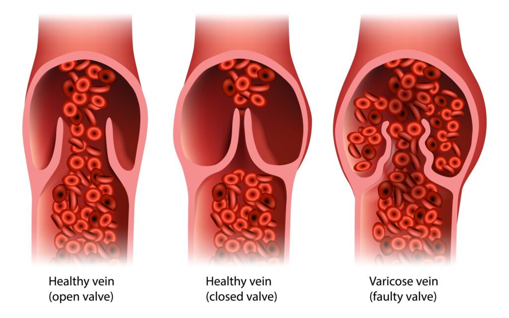 Venous insufficiency: 10 powerful benefits of a venous ultrasound for leg health 1 Venous insufficiency