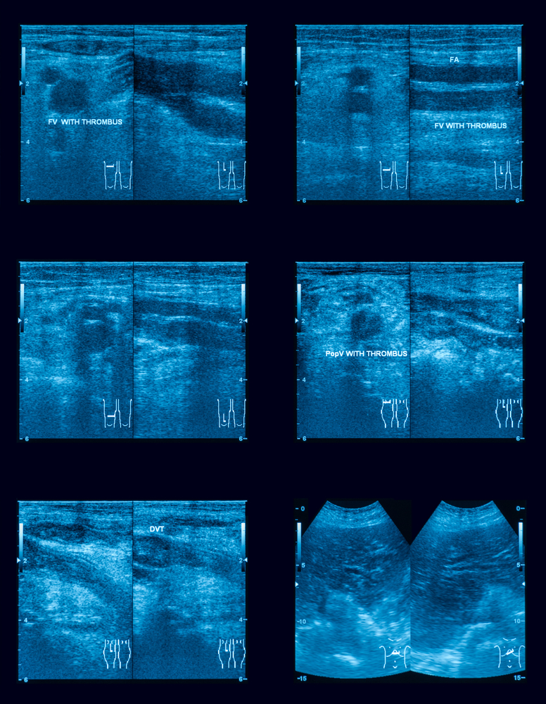 Venous vascular ultrasound vs. Venography 3 Venous ultrasound advantages, venography risks