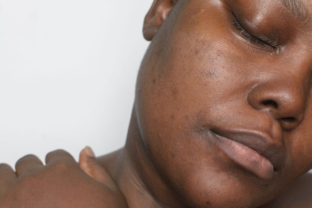 +7 Powerful Causes Of Dark Spots—and How To Fix Them Fast