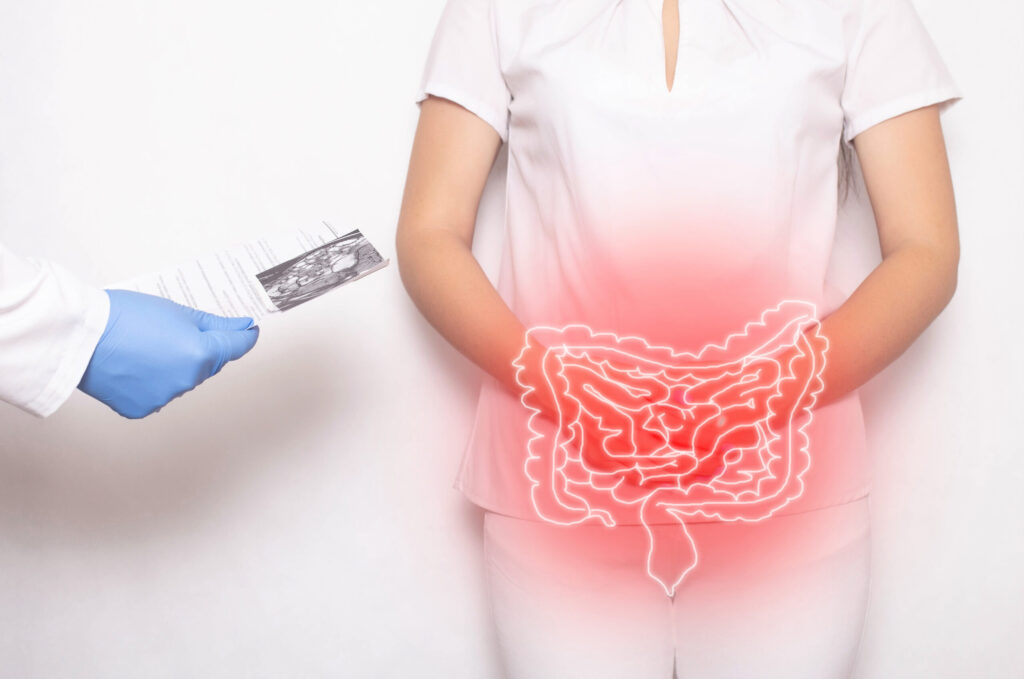 Managing colitis flares