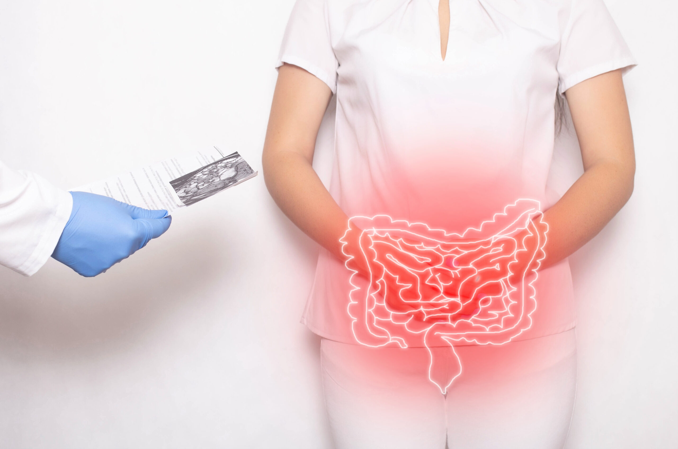 managing colitis flares