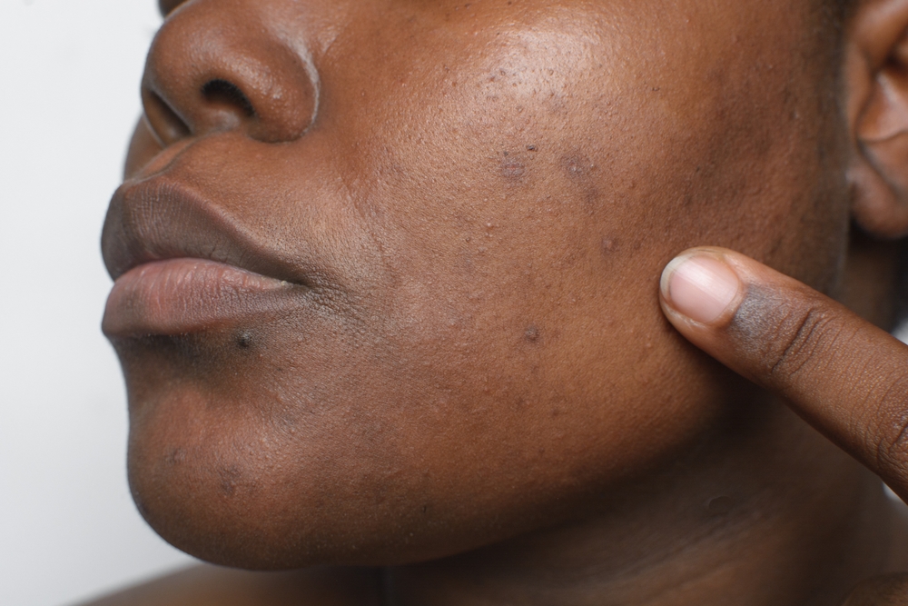 Pimples and Mental Health