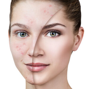 Young,Woman,With,Acne,Before,And,After,Treatment.