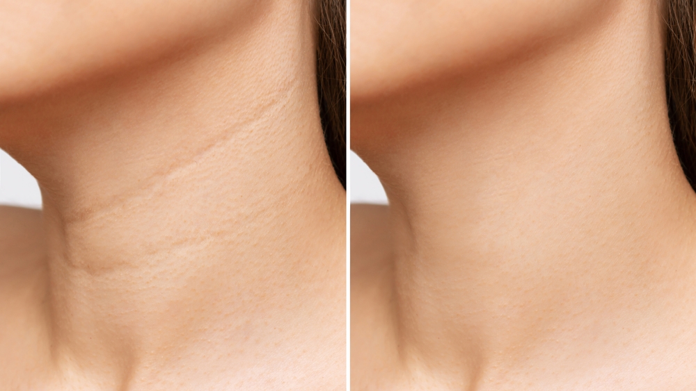 Necklines: +8 effective treatments to reduce them 1 Necklines