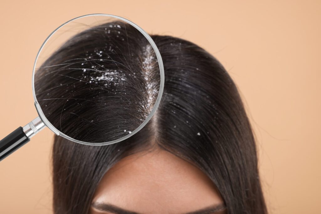 Prevent scalp dandruff: 7 useful dermatological tips 1 Scalp dandruff