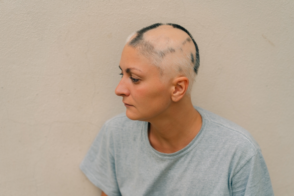 Alopecia areata: recognizing symptoms and causes of patchy hair loss 1 Alopecia areata