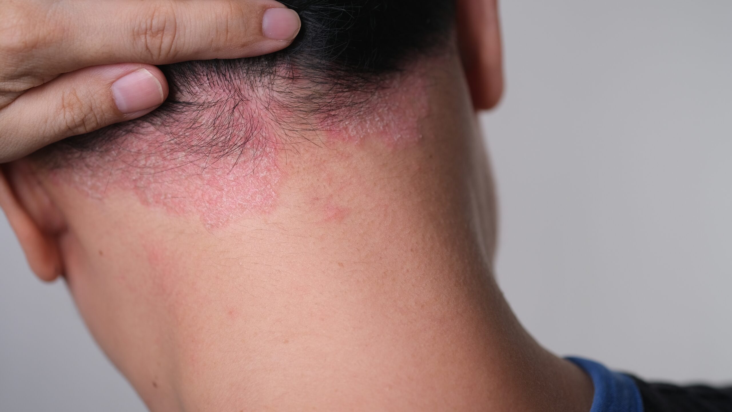 Scalp Irritation