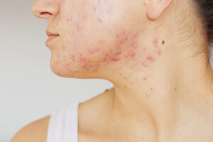 Image showcasing Top 6 Triggers Of Inflammatory Acne You Need To Know Right Now