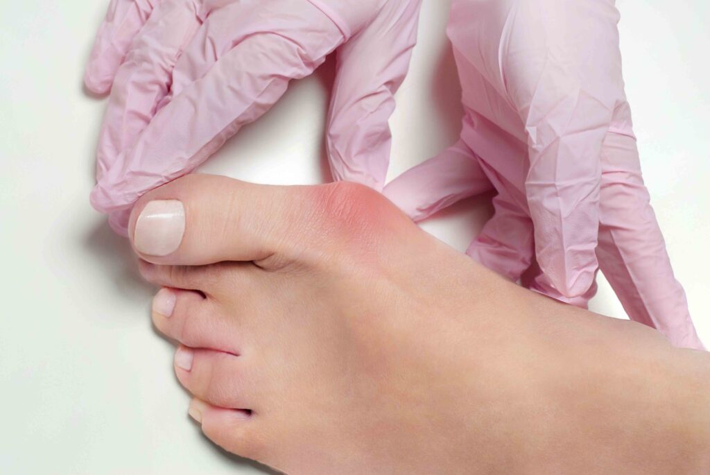 Bunions and foot joint deformities 5 Intervencion juanete