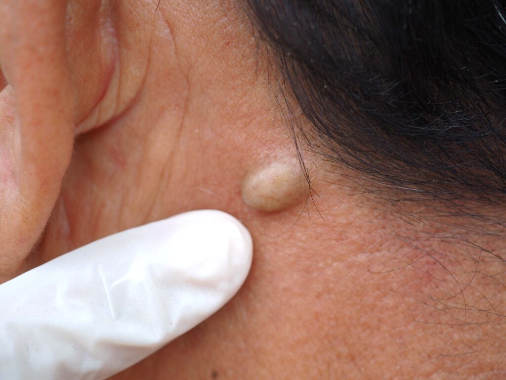 Skin biopsy