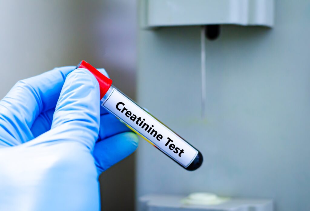 Medical illustration showing kidneys and blood test results indicating high creatinine levels associated with kidney function concerns.