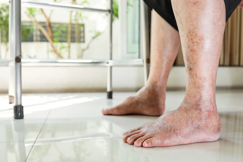 Peripheral artery disease (pad)  5 Pad feet