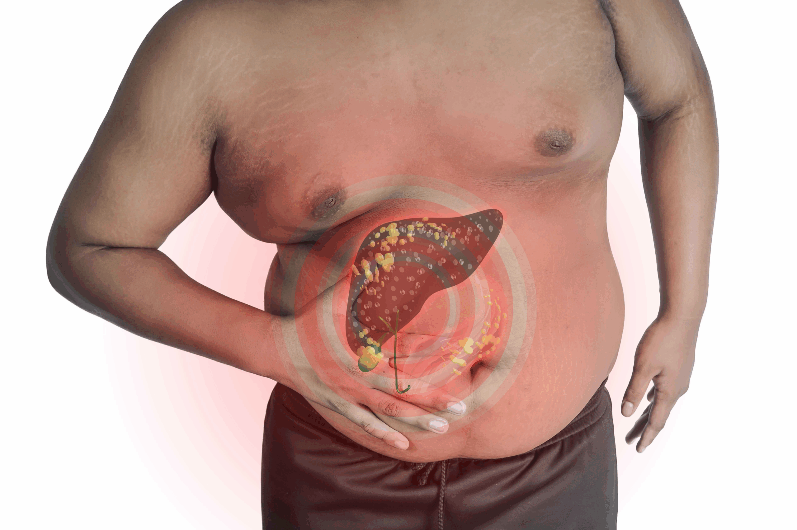 Fatty Liver Disease - Doral Health & Wellness NY