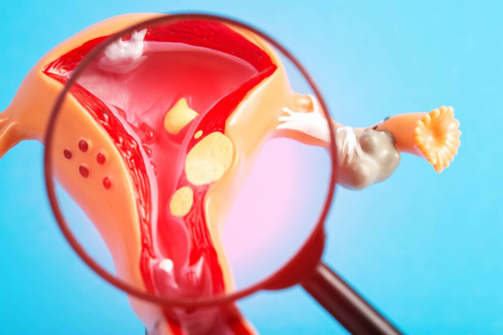 Noncancerous growths in the uterus, often during childbearing years, causing symptoms like heavy periods, pelvic pain, frequent urination, or no symptoms at all.