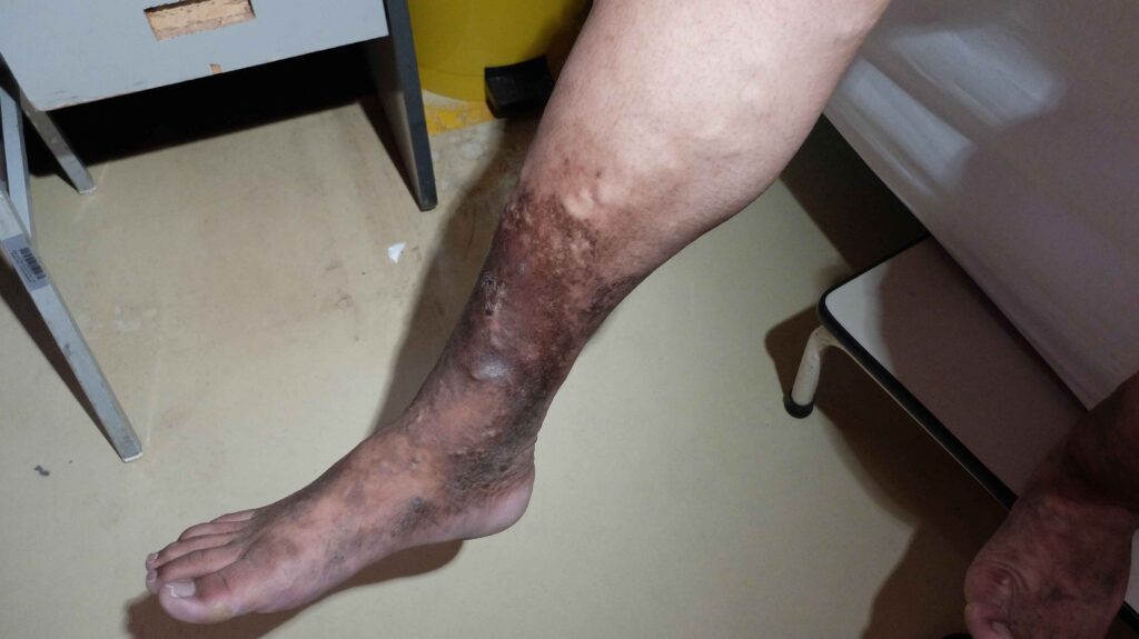 Chronic venous insufficiency (cvi)   7 Chronic venous insufficiency cvi