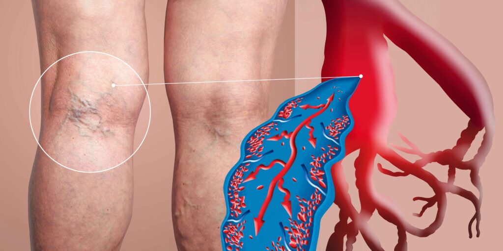 Deep vein thrombosis (dvt)  6 Deep vein thrombosis dvt