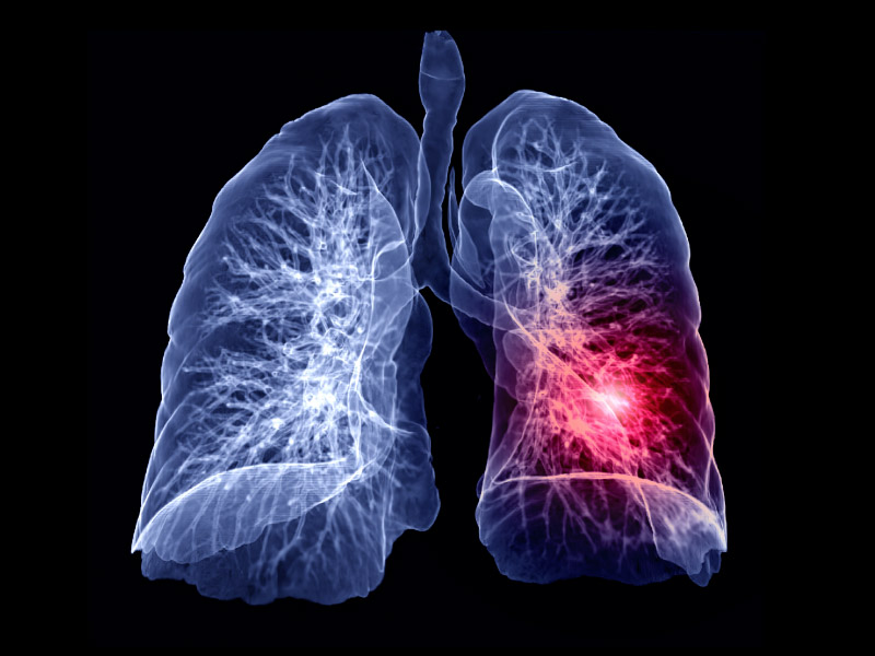 Pulmonary embolism  4 Pulmonary embolism