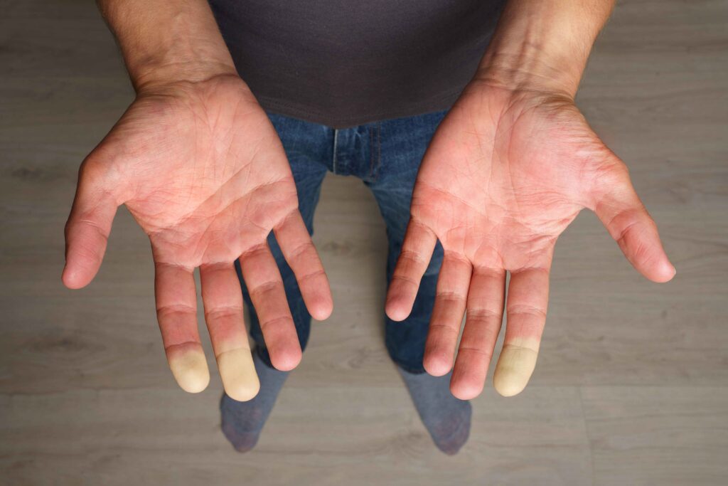 Raynaud's phenomenon  3 Raynauds phenomenon