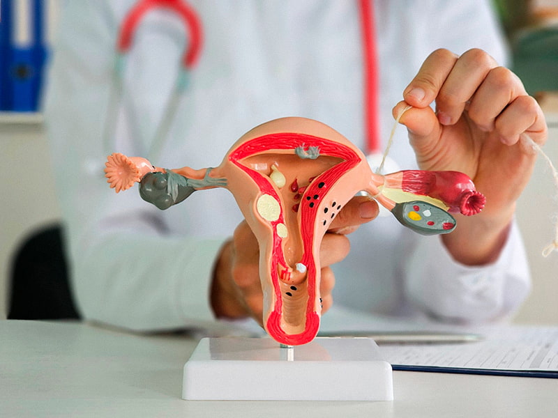 Tubal-ligation