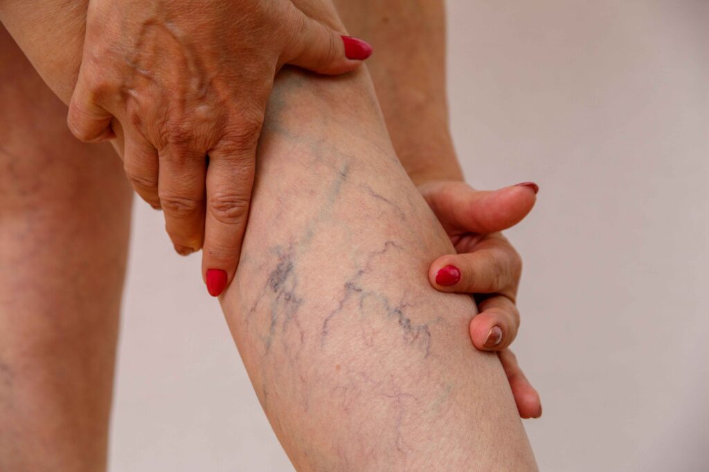 Varicose veins  1 Varicose veins