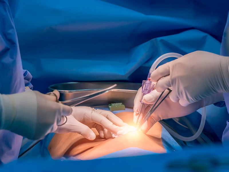 Laparoscopy