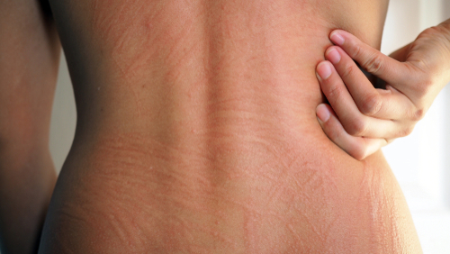 Stasis dermatitis: 8 key causes, early signs, and when to seek treatment 1 Stasis dermatitis