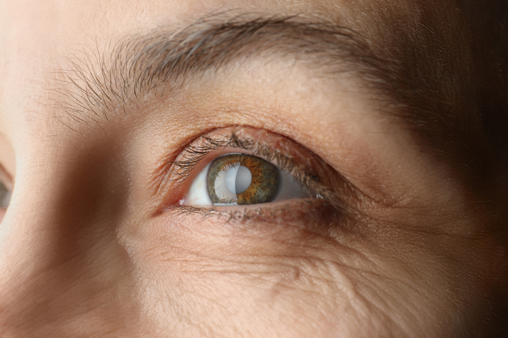 Cataract surgery