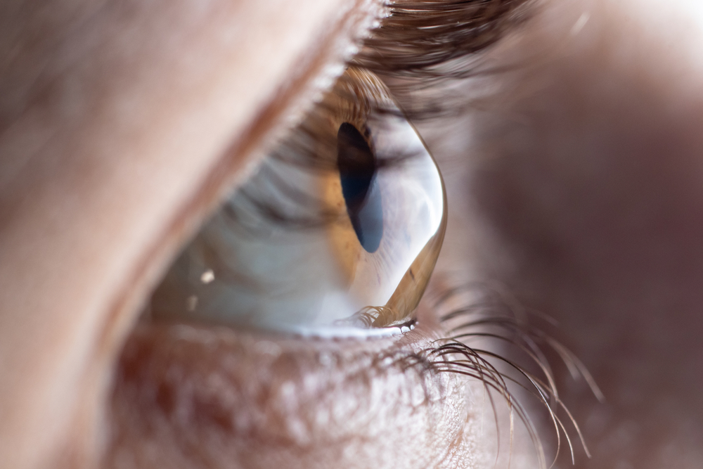 Corneal transplant