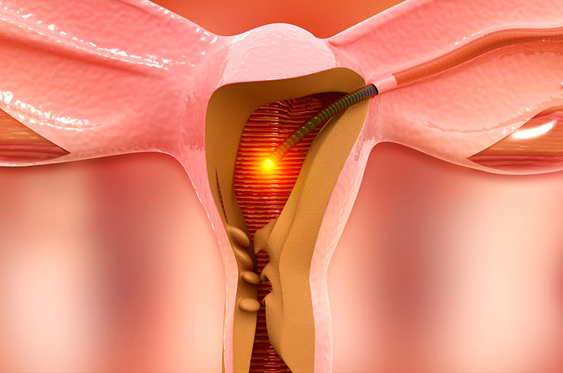 Dilation-and-curettage-dc