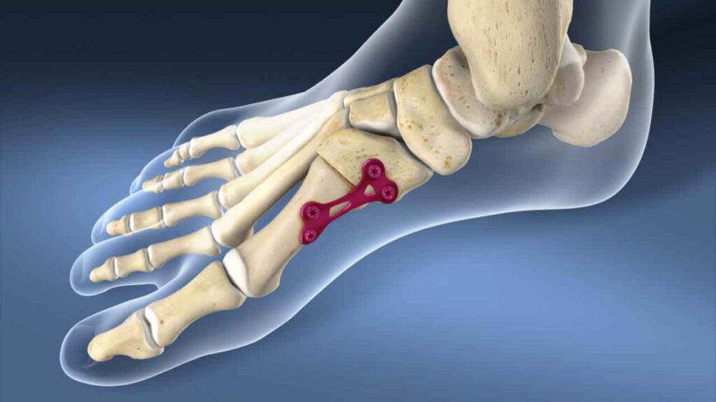 Foot bone fusion (arthrodesis) 1 Permanent joining of bones to stabilize painful or arthritic foot joints.