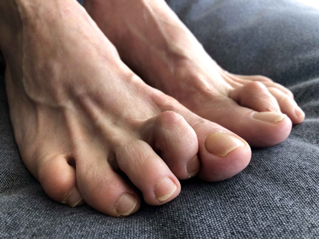 Hammertoe correction surgery 9 Straightening of curled toes to relieve pain and improve alignment.
