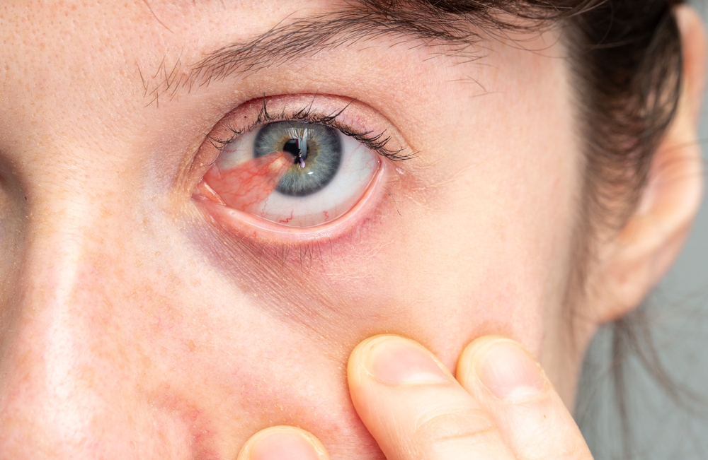 Pterygium surgery