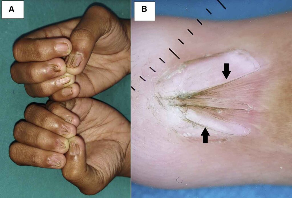 Pterygium surgery (nail pterygium release) 4 Surgical correction of pterygium unguis—skin overgrowth onto the nail plate.