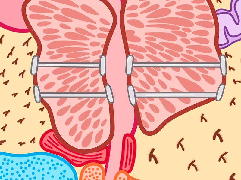 Urolift system