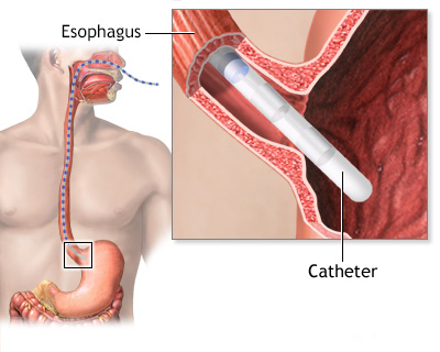 Esophageal manometry 4 24349