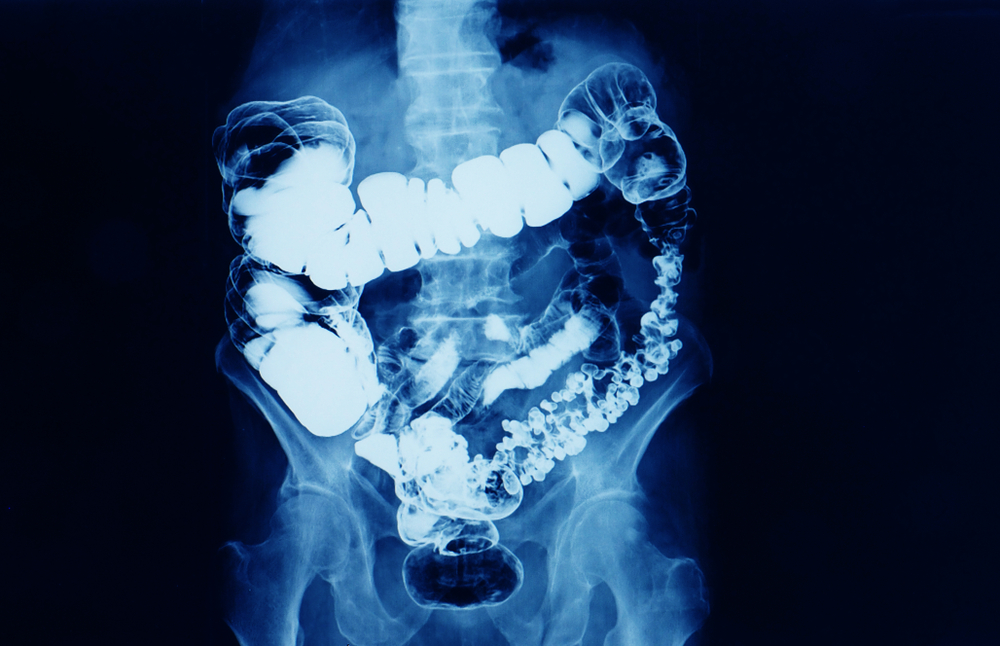 Barium enema 9 Shutterstock 1410677693