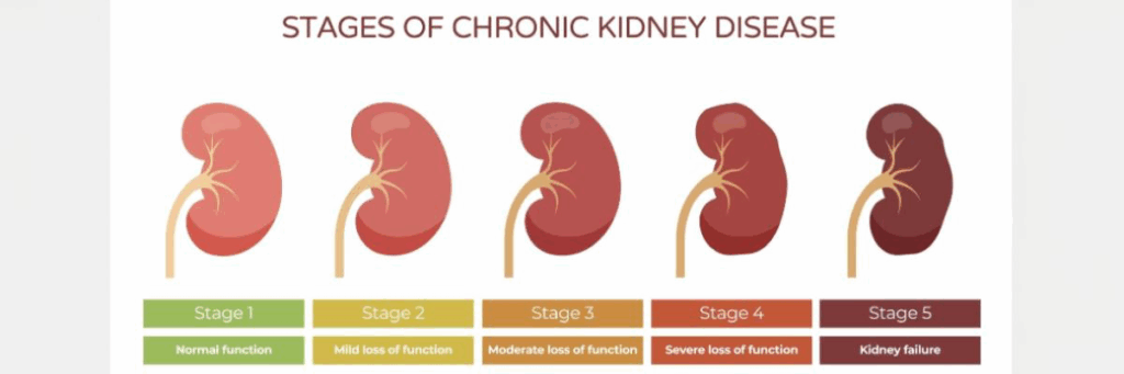 Chronic kidney disease stages explained: tests, symptoms, treatment 5 Chronic kidney disease stages explained tests symptoms treatment