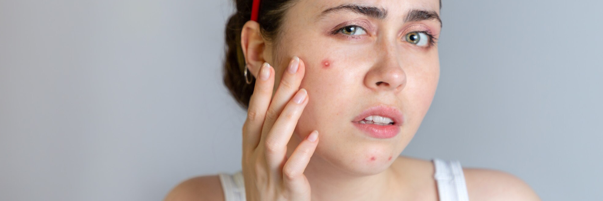 acne myths vs facts