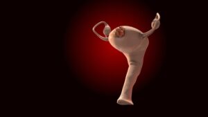 Woman managing symptoms of endometrial polyps while tracking menstrual health and improving quality of life