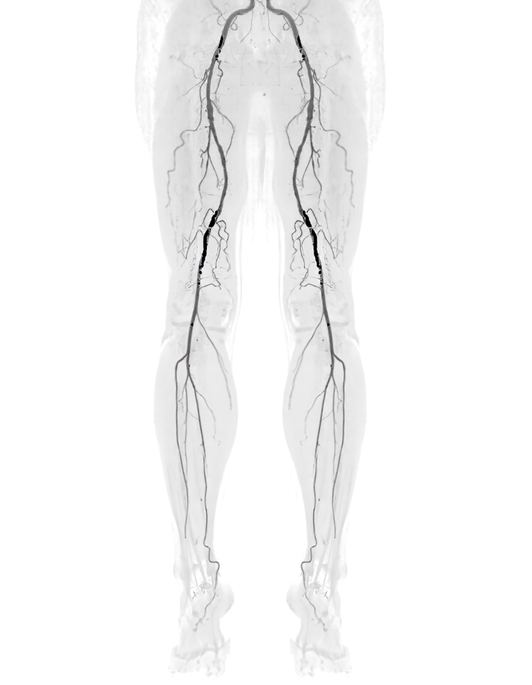 Peripheral artery disease (pad) treatment 3 Shutterstock 2206177135