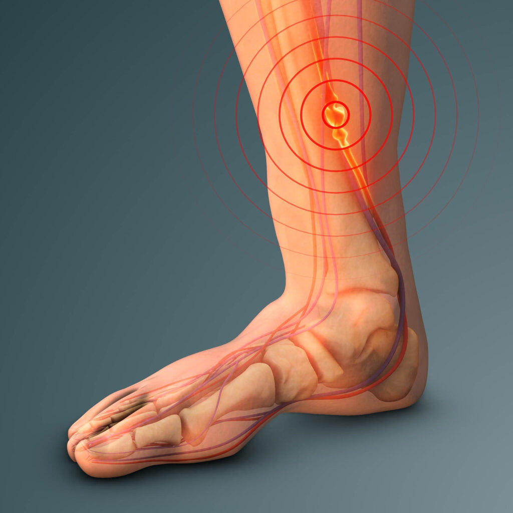 Deep vein thrombosis (dvt) treatment 7 Shutterstock 2609239623 l