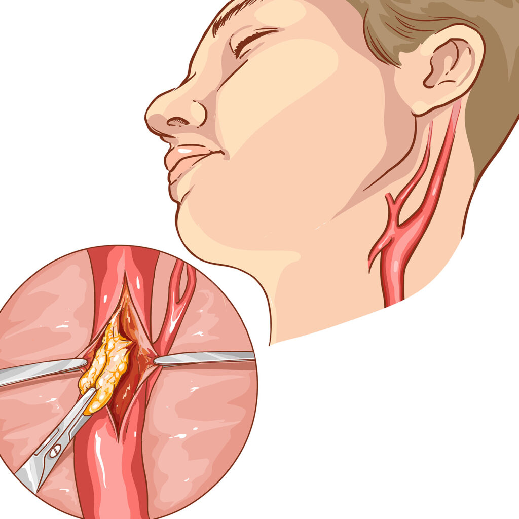 Carotid endarterectomy 8 Shutterstock 623913890 l