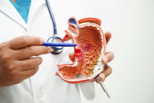 Ulcer symptoms: 9 key signs of h. Pylori or nsaid damage you must know 1 Ulcer symptoms