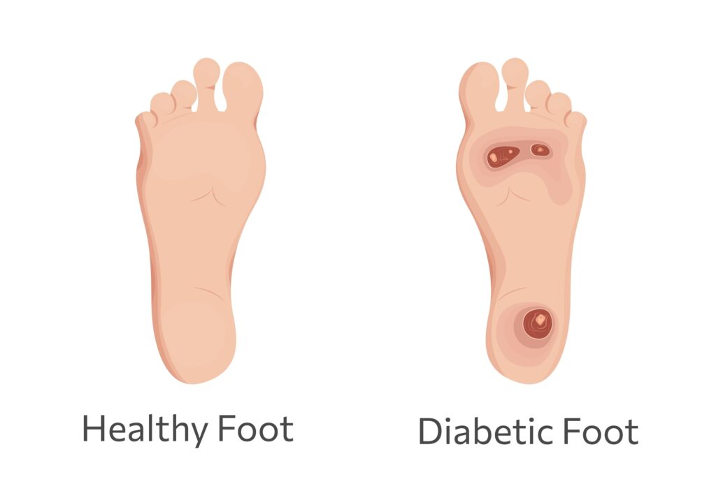 Diabetic foot